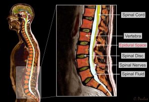 disc bulges | Arana Hills Physiotherapy